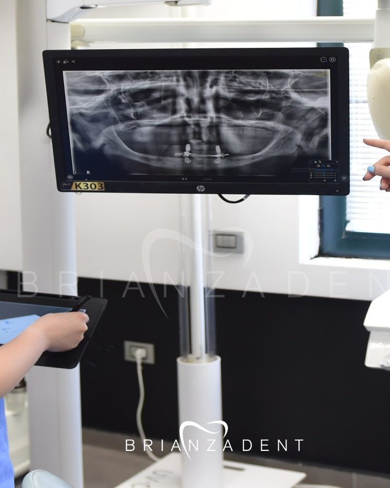 Planificación de las posiciones de los implantes sobre CBCT y escaneado intraoral antes de la cirugía de arcada completa