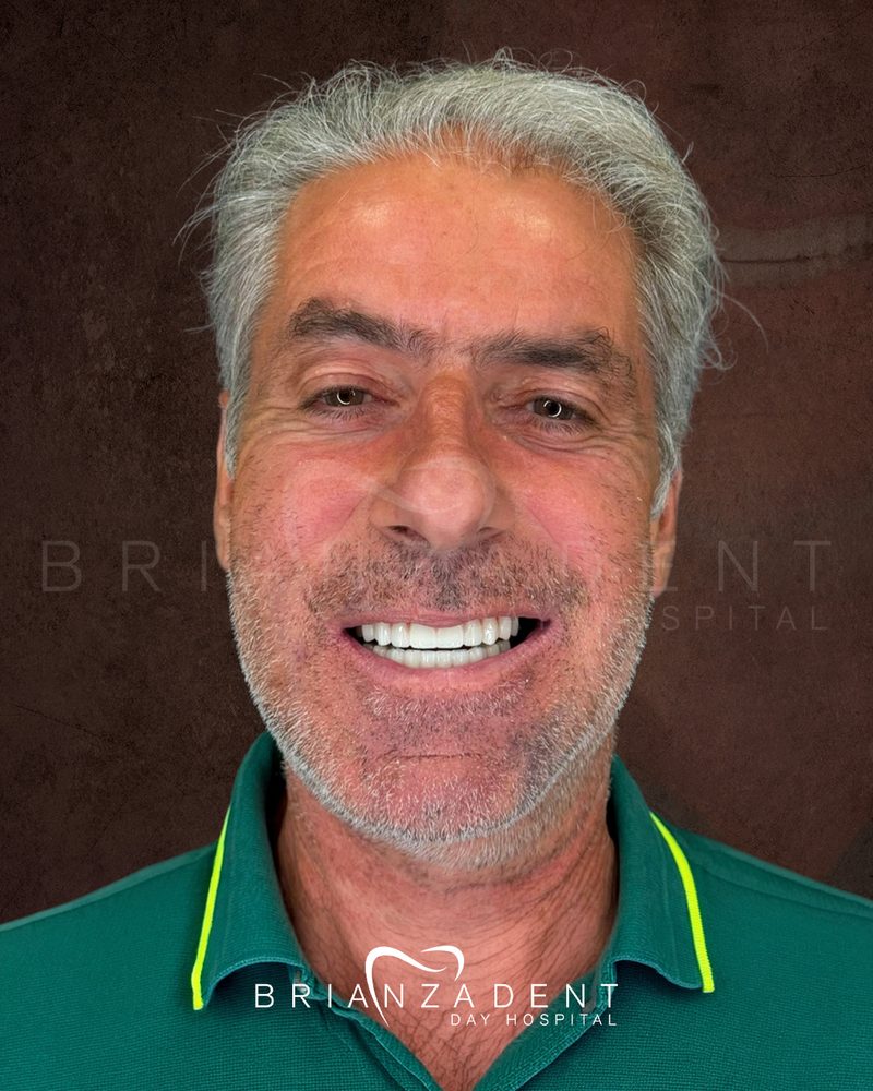 Después del tratamiento: ambas arcadas restauradas en una rehabilitación oral completa en Brianza Dent, publicado con el consentimiento escrito del paciente