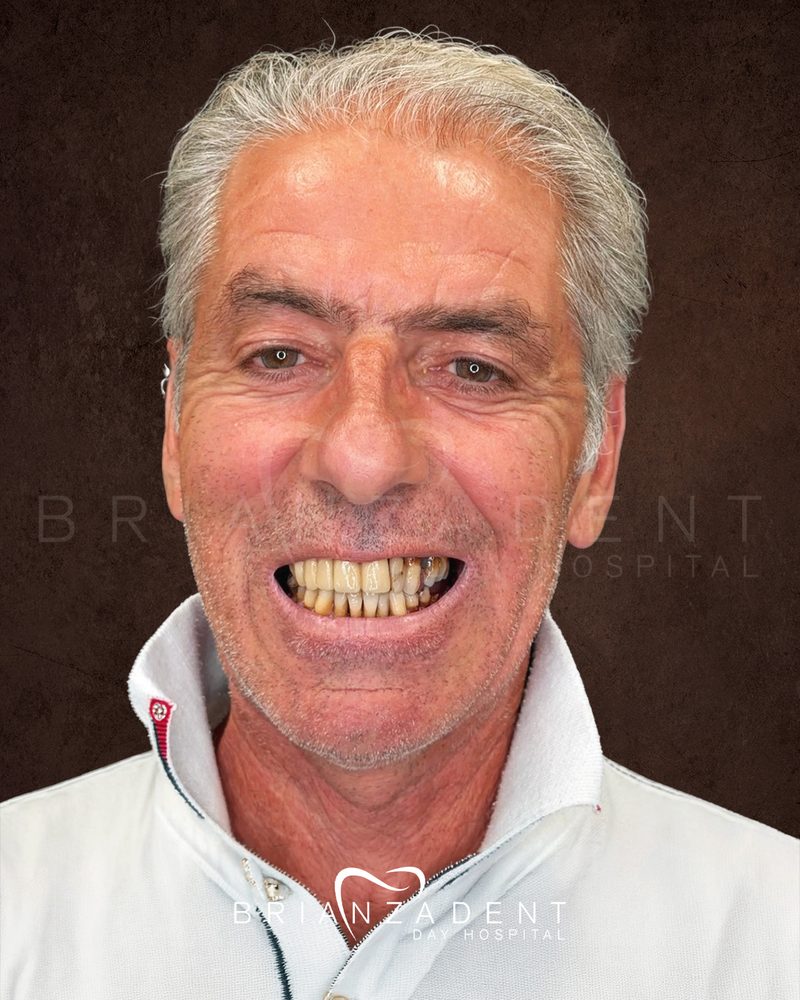 Antes del tratamiento: dientes desgastados y cariados en ambas arcadas previo a la rehabilitación oral completa, publicado con el consentimiento escrito del paciente